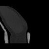 SPORK, NICO - 22.03.1976 - 02.08.2022 - CT obere Extremität - 18:01:46